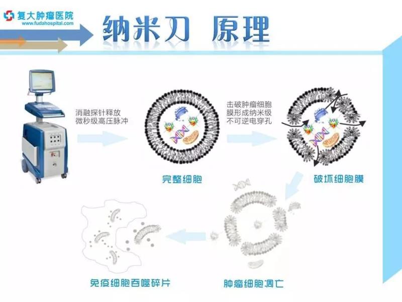 手术"暗雷"遍布 纳米刀巧除"拦路虎"